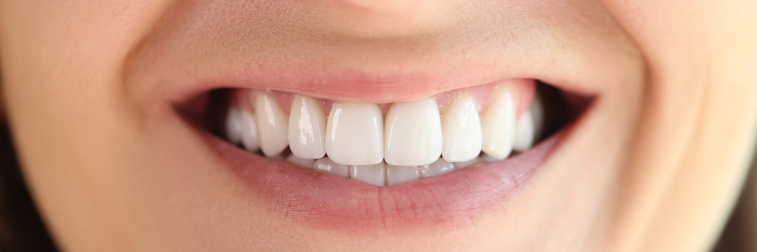Close up of a healthy white smile after white spot removal treatment